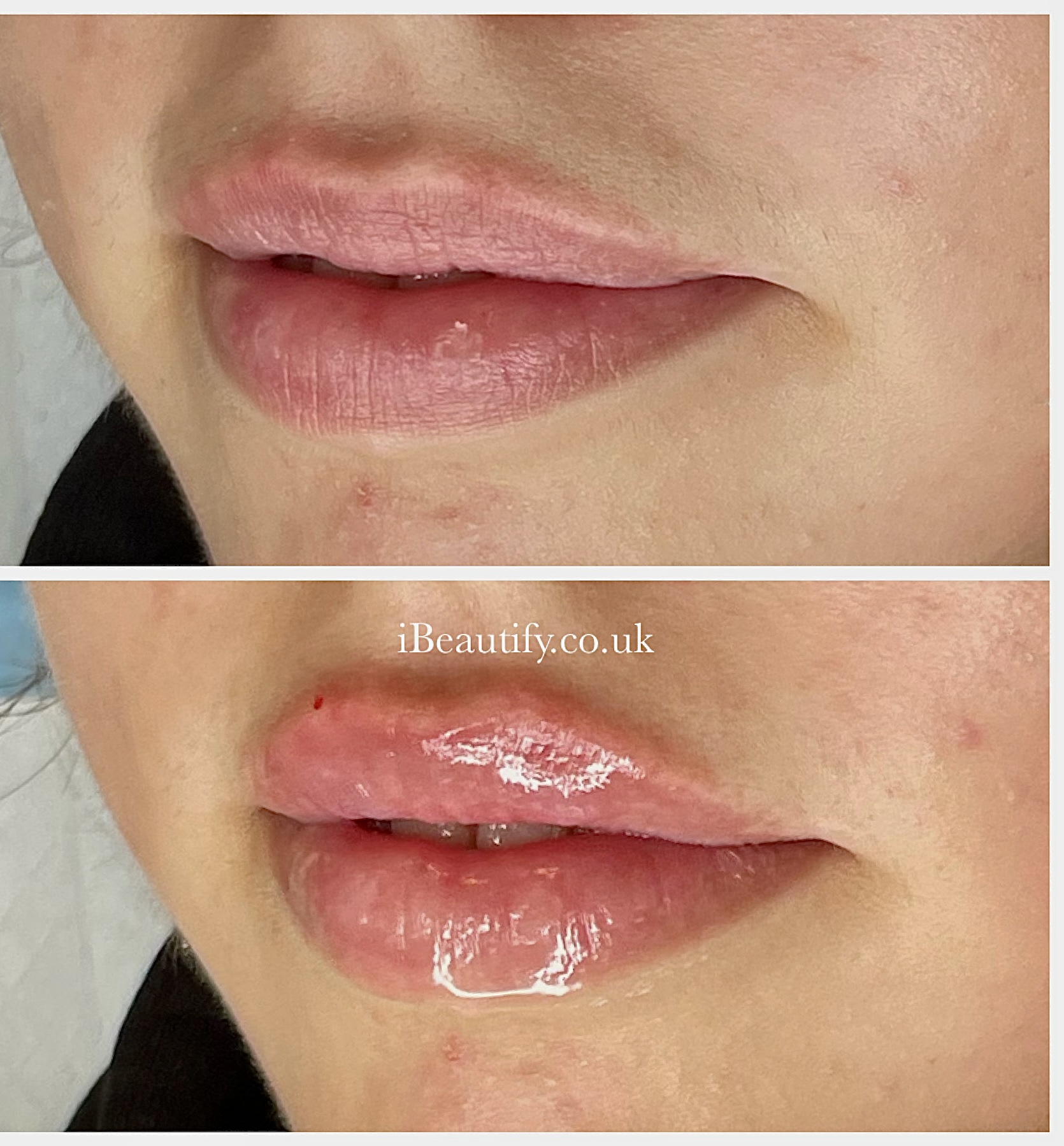 Lip Enhancement - before and after at iBeautify, Tunbridge Wells