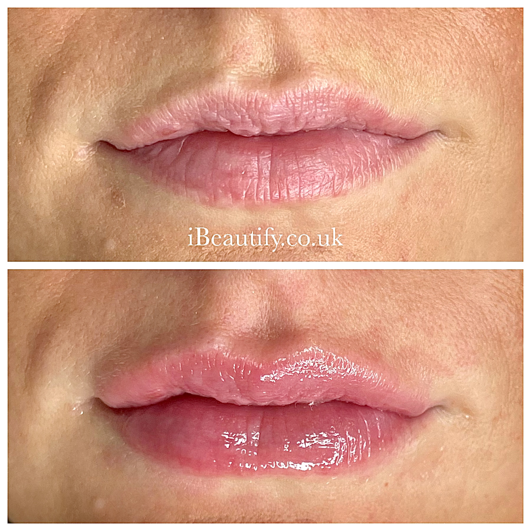 Natural Lip Enhancement before and after - iBeautify Tunbridge Wells