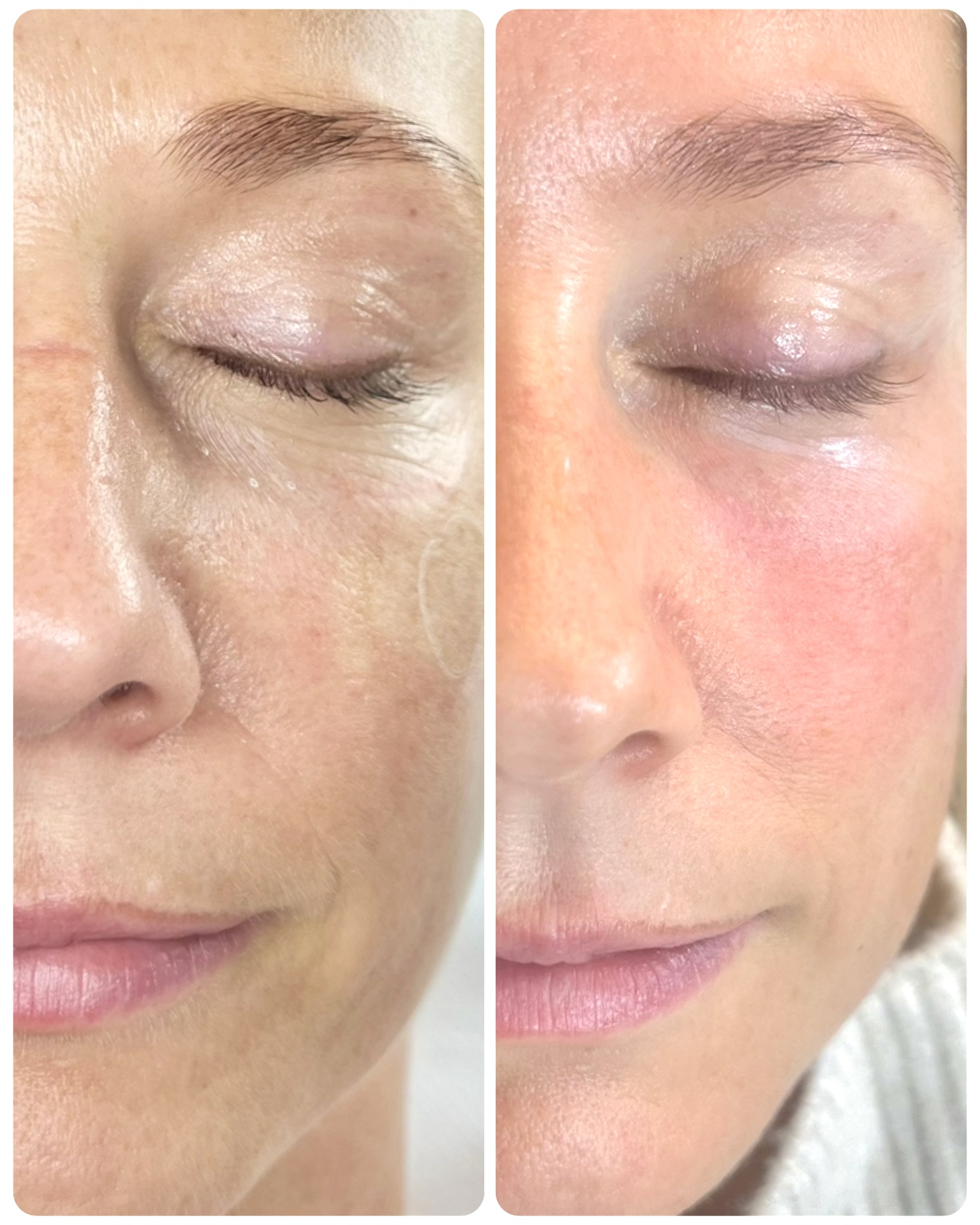 Skin Hydration Treatment - before and after at iBeautify, Tunbridge Wells