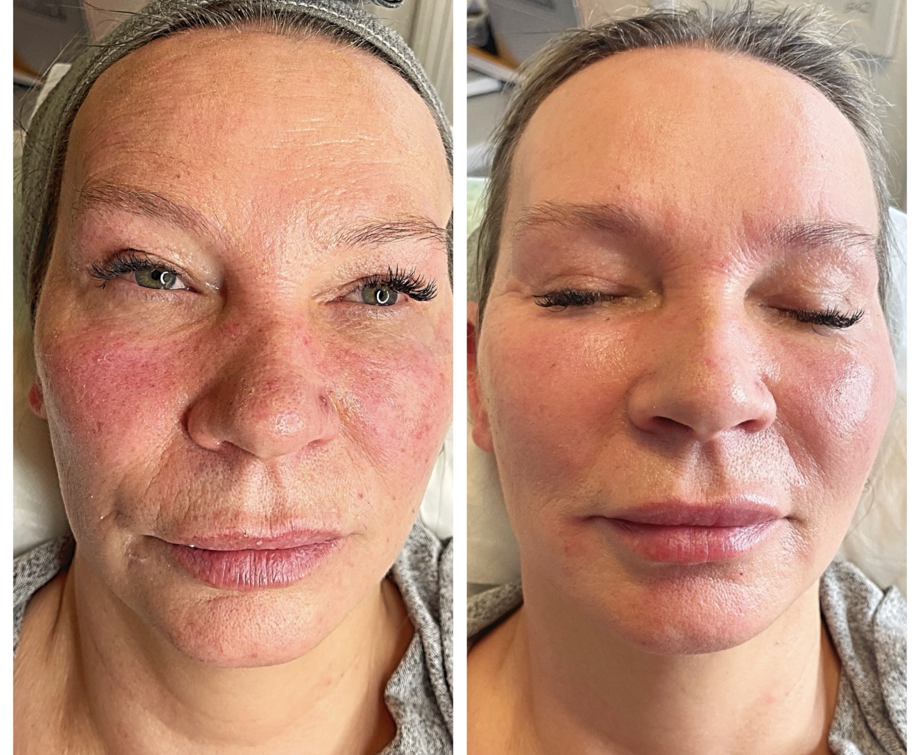 Rosacea & Redness before and after - iBeautify Tunbridge Wells