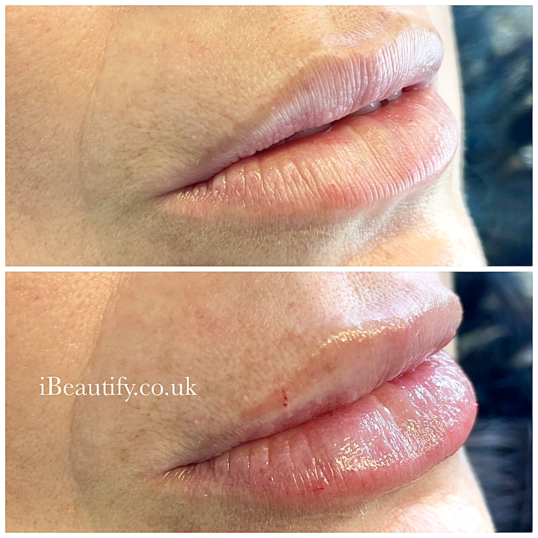 Lip Filler - before and after at iBeautify, Tunbridge Wells