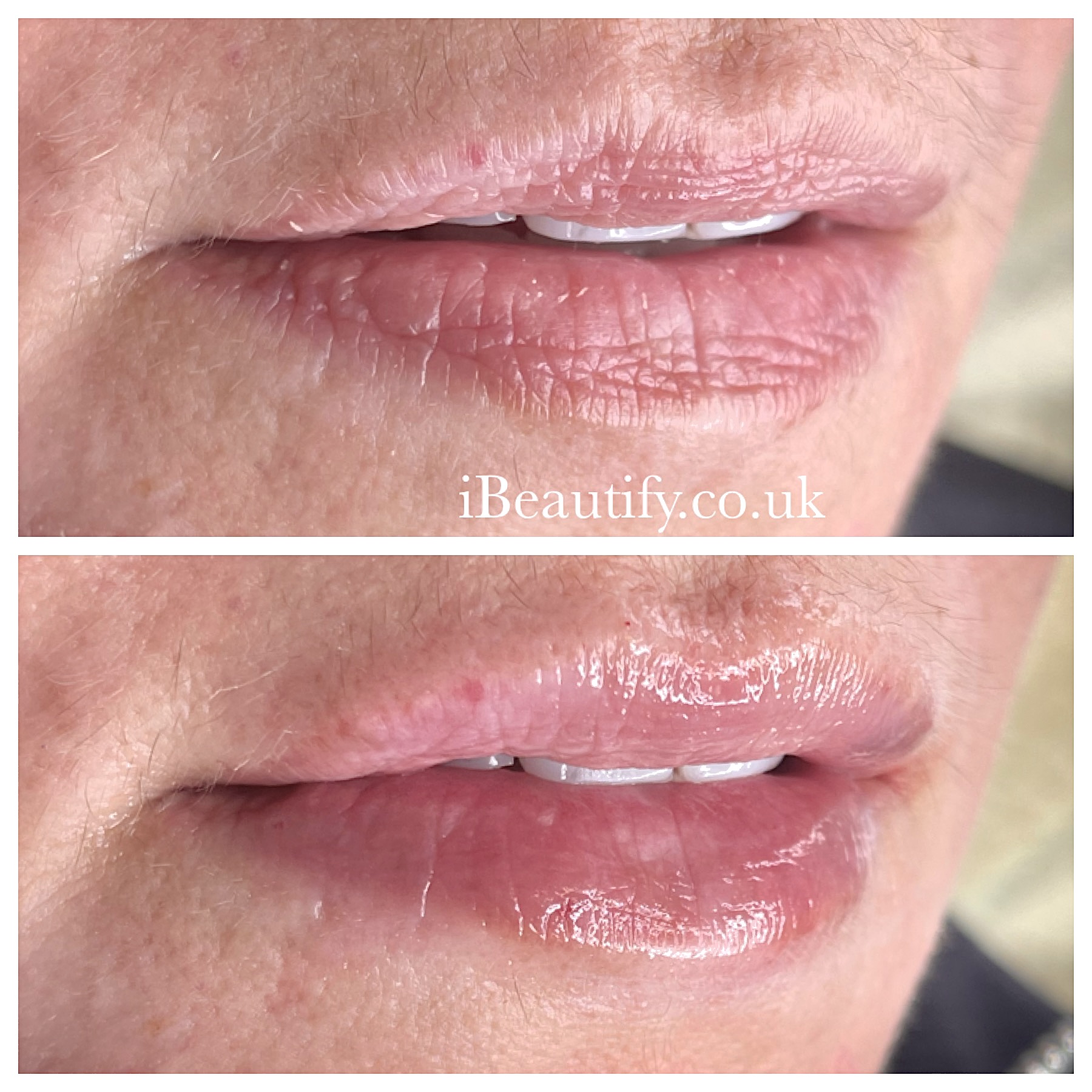 Lip Volume & Definition - before and after at iBeautify, Tunbridge Wells