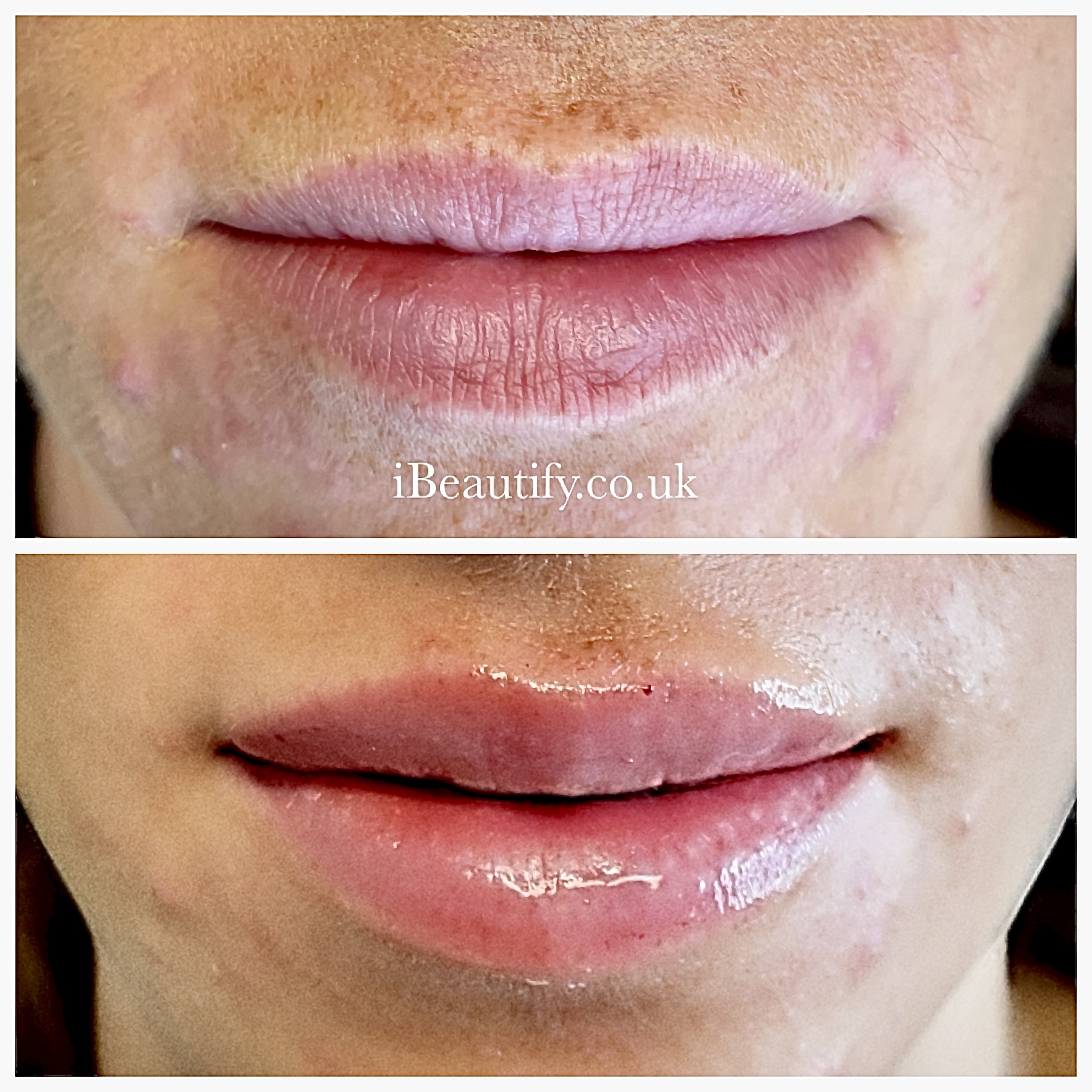Lip Enhancement - before and after at iBeautify, Tunbridge Wells