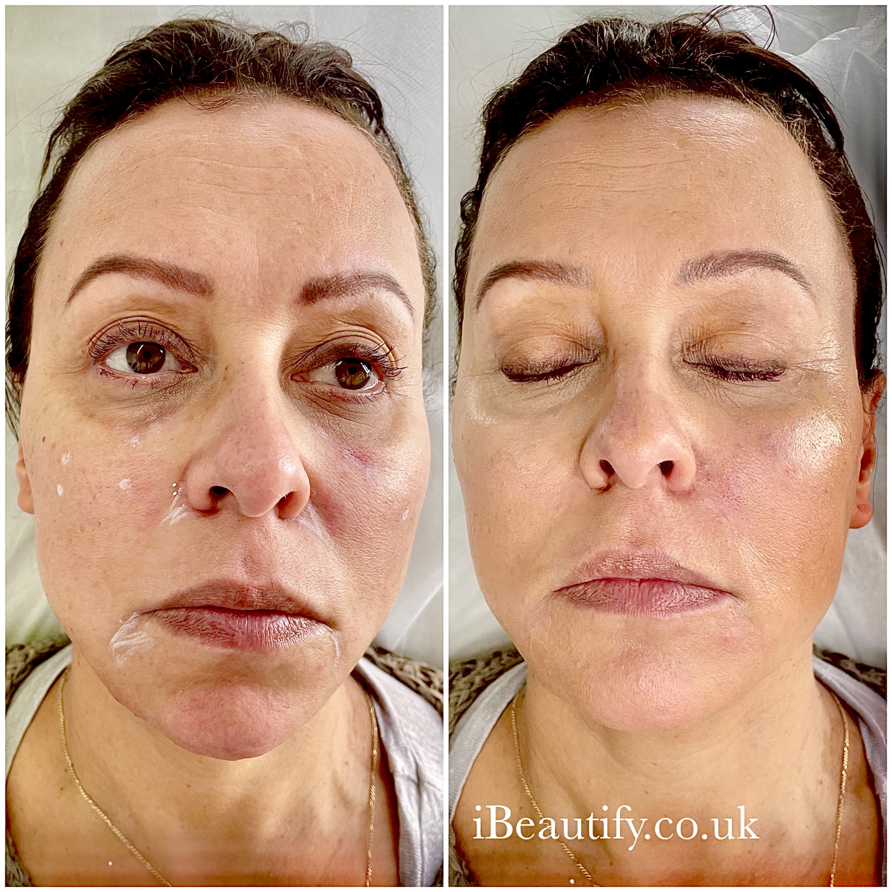 Multi-Area Rejuvenation - before and after at iBeautify, Tunbridge Wells
