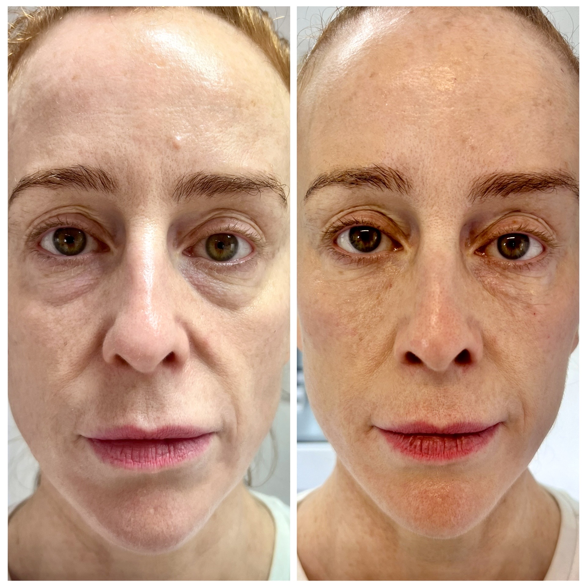 Full Face Rejuvenation before and after - iBeautify Tunbridge Wells